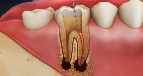 Tủy răng là gì? Chức năng và một số bệnh lý về tủy răng