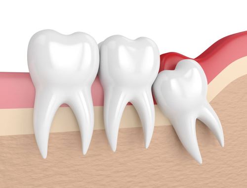 Nhổ răng khôn tại Nha khoa Ruby Luxury - Giải pháp an toàn và hiệu quả cho sức khỏe răng miệng của bạn
