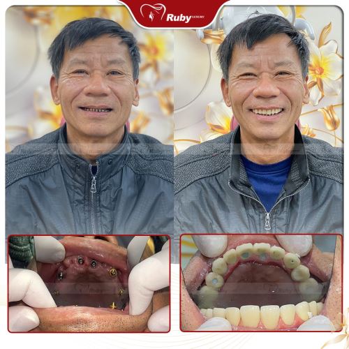 Răng implant - Giải pháp hiệu quả cho việc thay thế răng mất và Nha khoa Ruby Luxury - Địa chỉ uy tín để làm răng implant