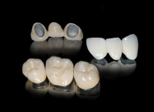 Răng sứ kim loại và tác hại đến sức khỏe: Tại sao nên chọn răng sứ không kim loại và Nha khoa Ruby Luxury làm địa chỉ tin cậy?"