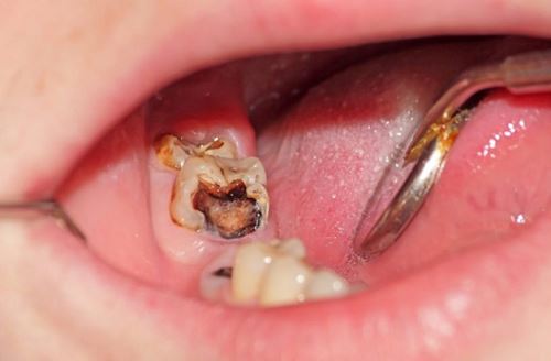 Cách xử lý khi bị răng sâu và Nha khoa Ruby Luxury - Địa chỉ uy tín để điều trị răng sâu