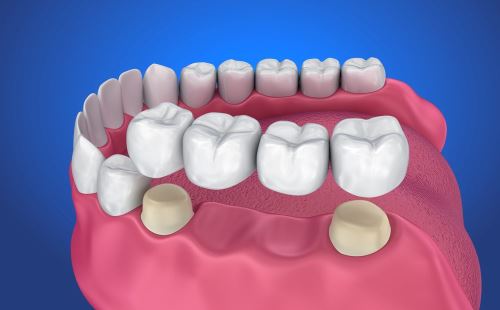 Cầu răng sứ là gì? Và cầu răng sứ tồn tại trong bao lâu