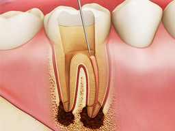 Điều trị tủy răng