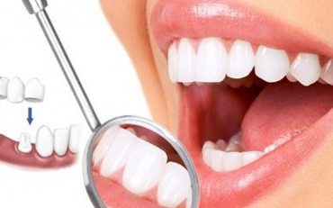 Bọc răng sứ có đau không nhỉ?