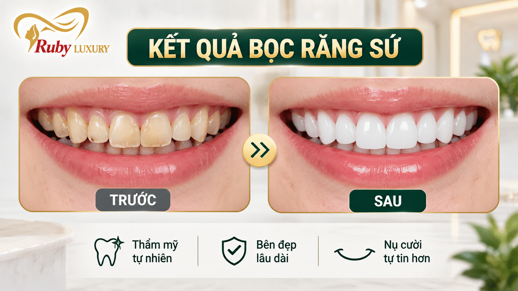 Kết quả bọc răng sứ