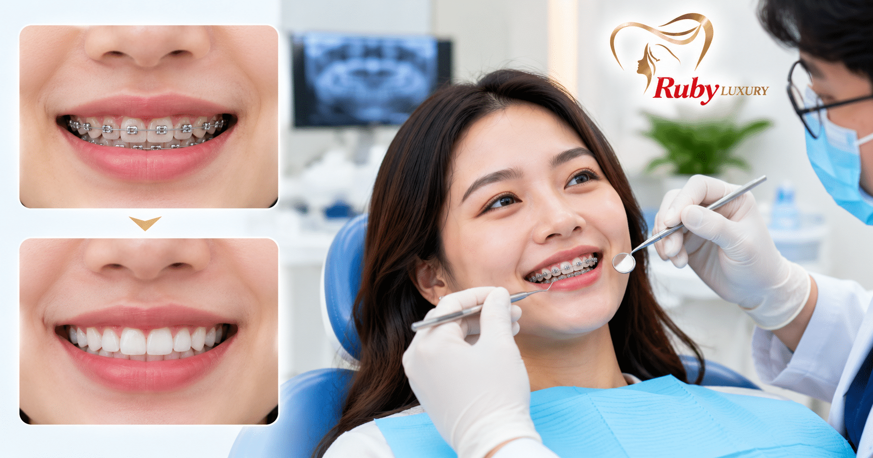 Dịch vụ niềng răng thẩm mỹ tại Ruby Luxury